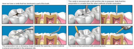 Composite restoration