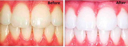 Bleaching