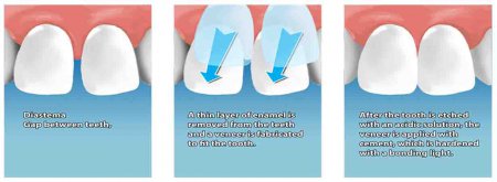 Veneering of teeth