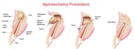 Apicoectomy