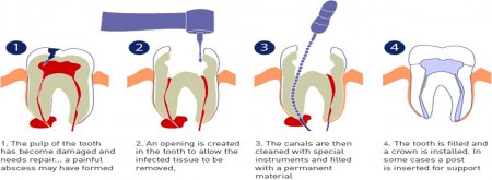 Pulpectomy