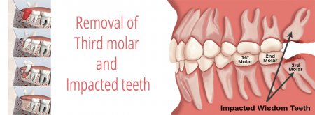 Removal of third molar and impacted teeth