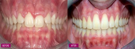 Gingivectomy