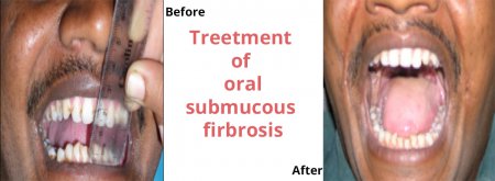 Treetment of oral submucous firbrosis
