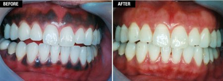 Gingival depigmentation