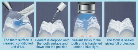 Pit and fissure sealant