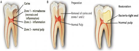 Pulpotomy