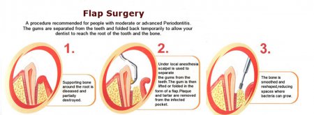 Flap surgery