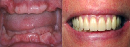 Dental implant (single & full mouth)