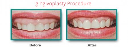 Gingivoplasty