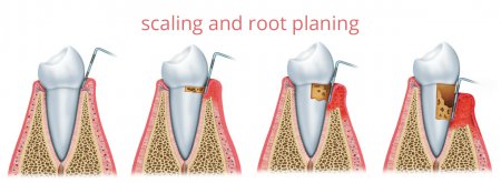 Scaling and root planing