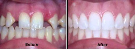 Smile designing