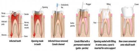 Root canal