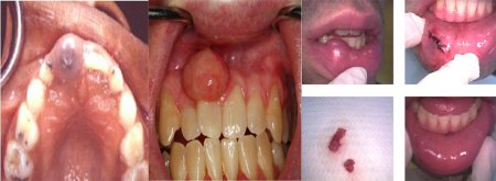Removal of cyst and tumours