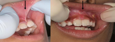 Frenectomy