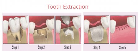 Tooth extraction